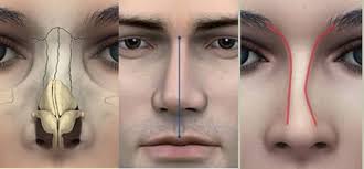 Symptômes nez cassé, Diagnostic fractures nez, Traitement nez cassé