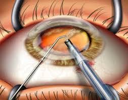 chirurgie cataracte