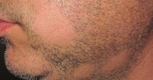 alopécie de barbe